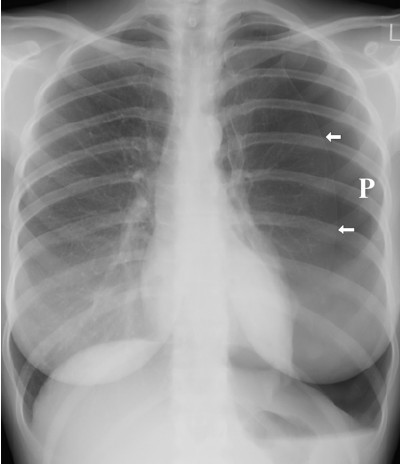 Pneumothorax - Rx
